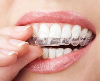 Invisalign Pearlfection Dentistry Frederick Maryla
